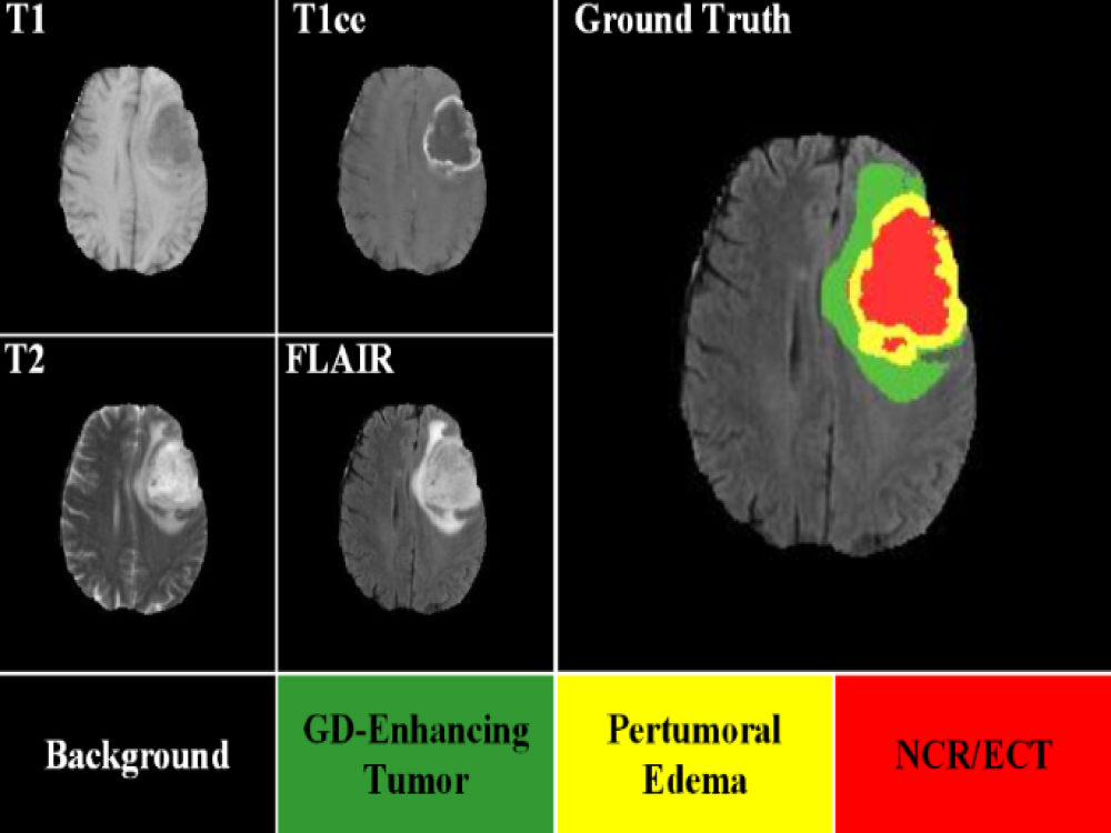 Brain Tumor Segmentation